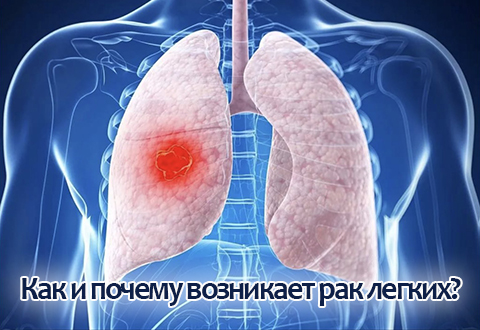 Как и почему возникает рак легких